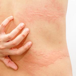 Itch worsens mental health in dermatological patients