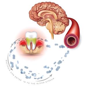 Gum disease tied to stroke risk